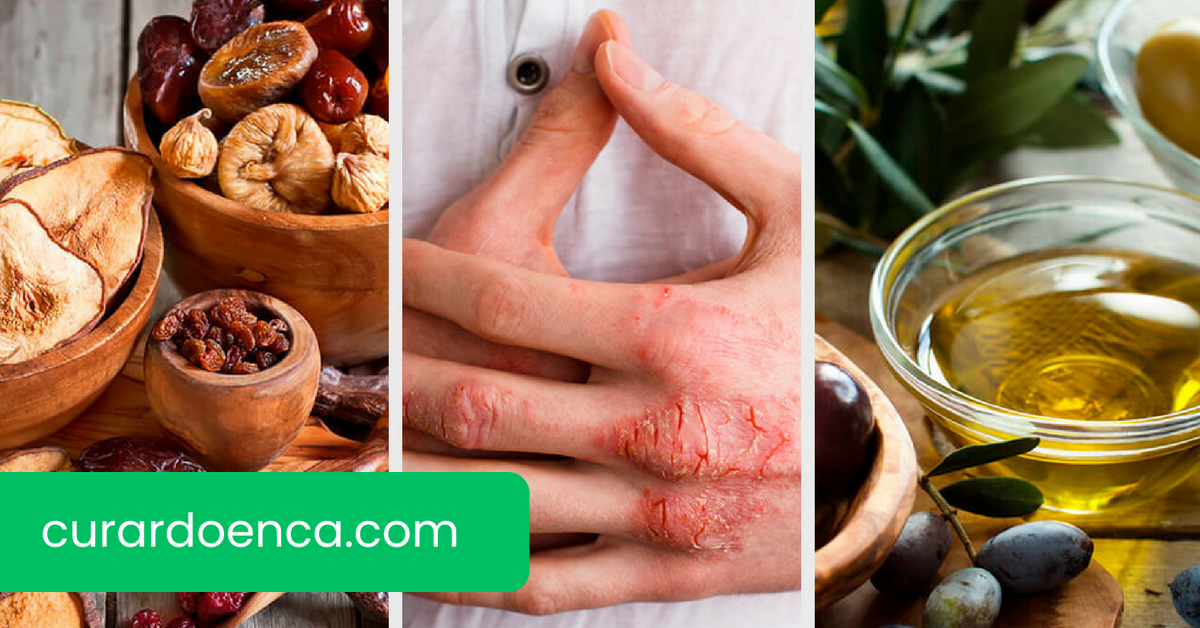 eczema (Imagem divulgação)