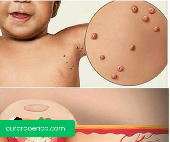 Molusco Contagioso (imagem divulgação)