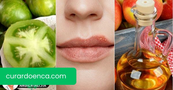 Herpes em crianças: como tratá-lo?