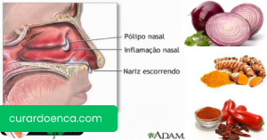 5 remédios caseiros para pólipos nasais