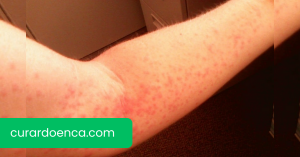 alergia (Imagem divulgação)