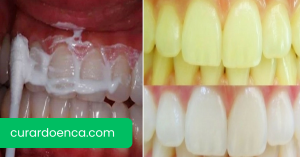 dentes (Imagem divulgação)