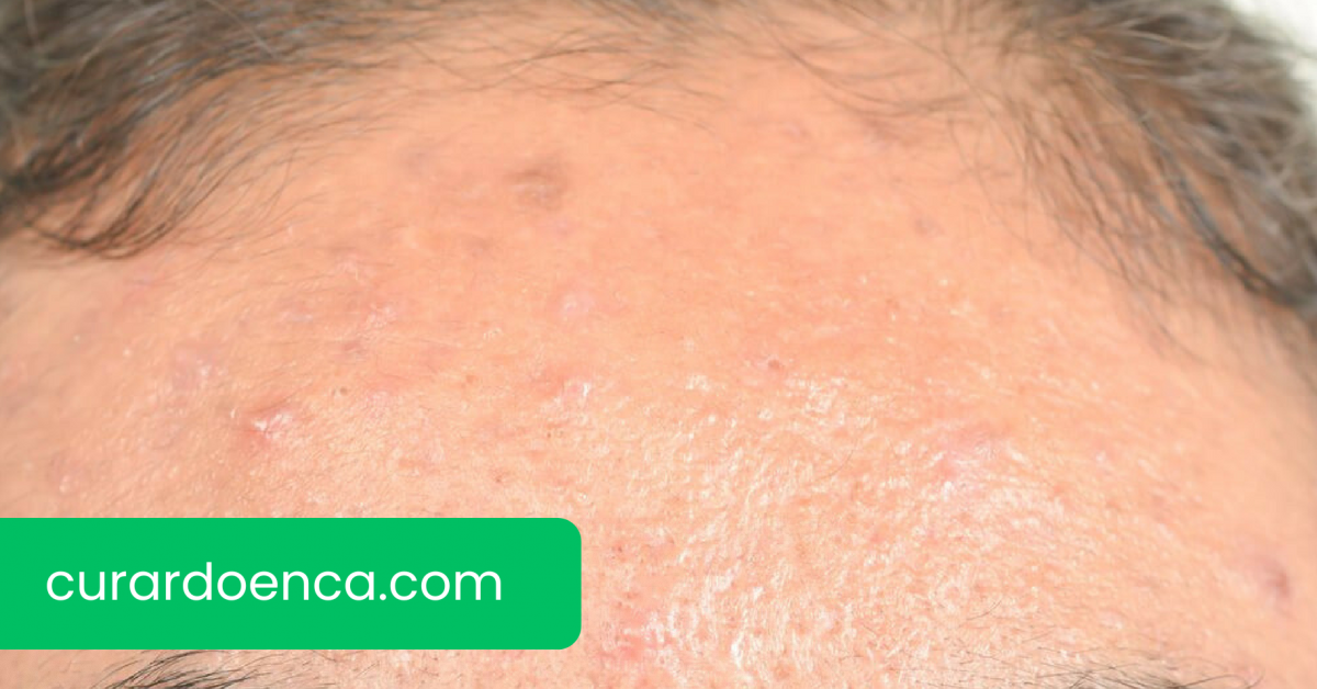 dermatite (Imagem divulgação)