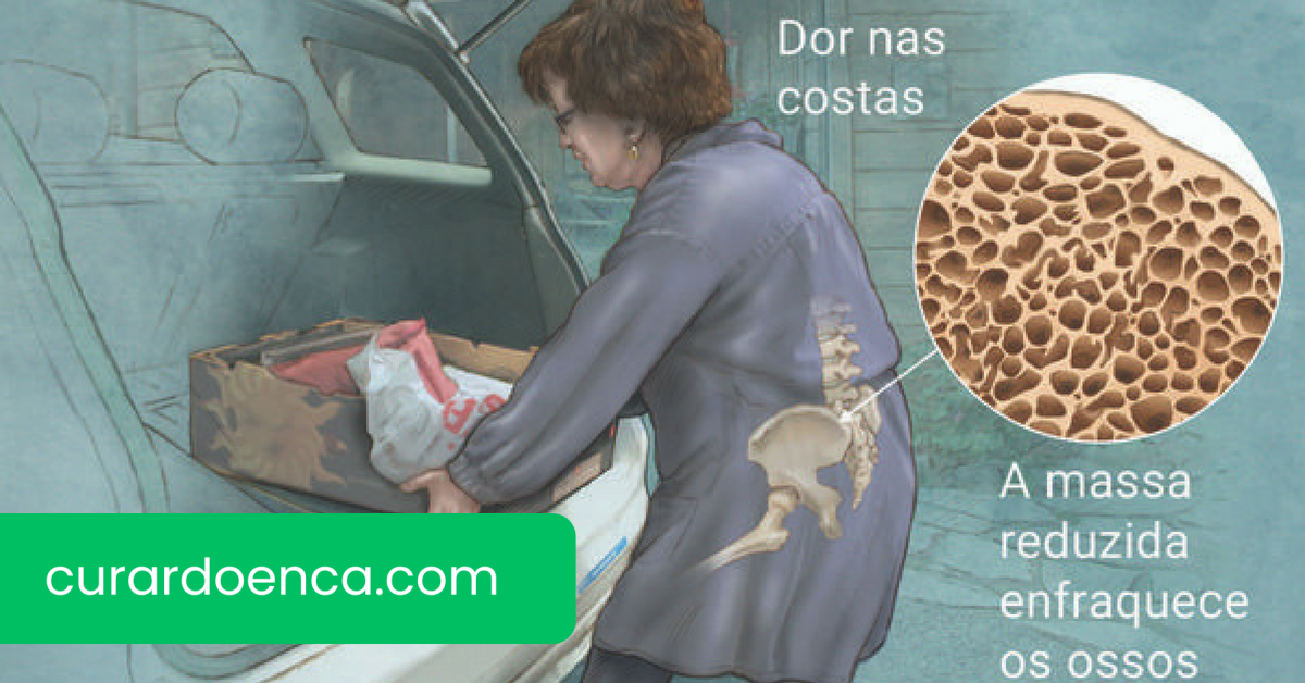 osteoporose (imagem divulgação)