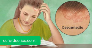psoríase (Imagem divulgação)