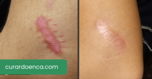 queloides (Imagem divulgação)