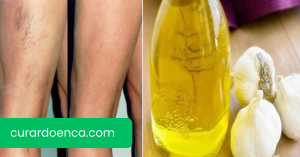 varizes (Imagem divulgação)