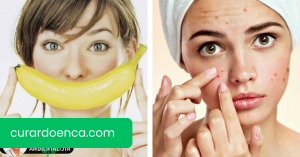 5 máscaras com banana para embelezar sua pele e cabelo