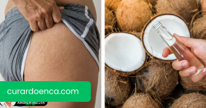 5 tratamentos com óleo de coco para reduzir as estrias e cicatrizes