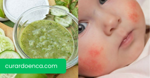 dermatite (Imagem divulgação)