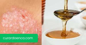 eczema (Imagem divulgação)