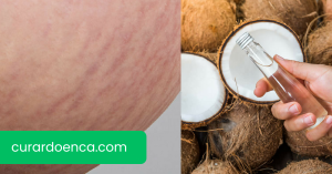 estrias (Imagem divulgação)