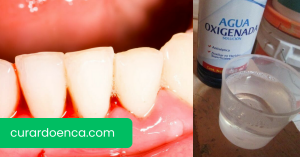 gengivite (Imagem divulgação)