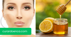 hiperpigmentação (Imagem divulgação)