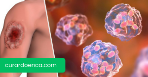 leishmaniose (Imagem divulgação)