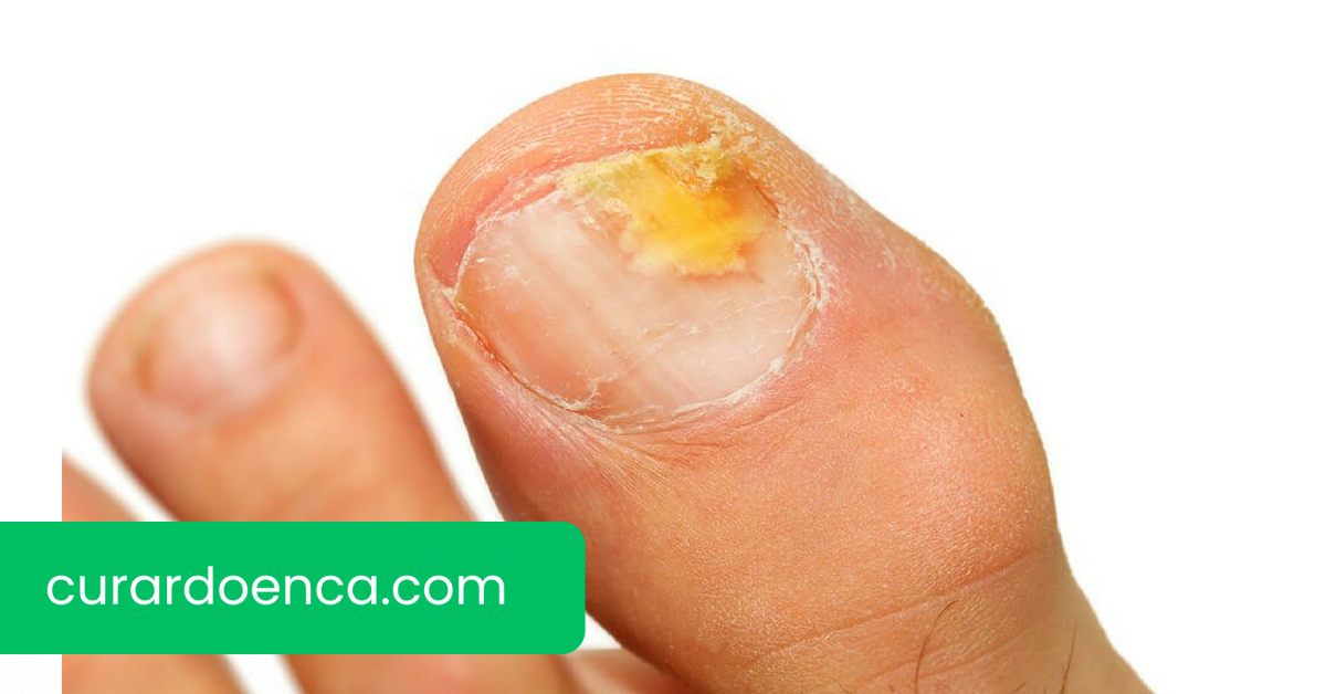 micose (Imagem divulgação)