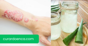 psoríase (Imagem divulgação)