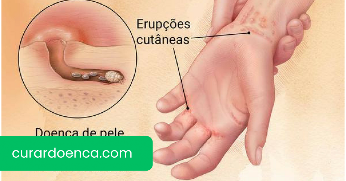 sarna (Imagem divulgação)