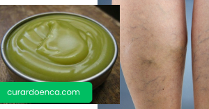 varizes (Imagem divulgação)