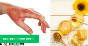 Como curar uma queimadura com remédios caseiros