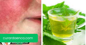 Remédios naturais para tratar os sintomas da escarlatina