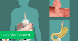 Hérnia de hiato: causas e remédios naturais para tratá-lo