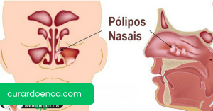 Como curar pólipos nasais com 5 soluções caseiras