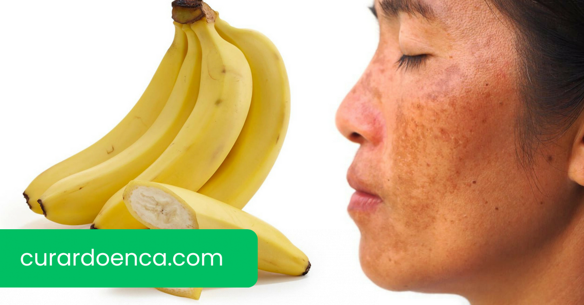 melasma (Imagem divulgação)