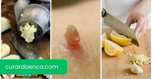 Preparações medicinais para remover as verrugas naturalmente