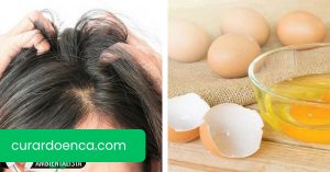 Sofre de coceira no coura cabeludo? Veja como acabar com ela