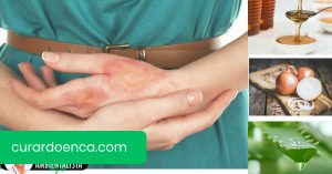 Queimaduras nos dedos: 7 remédios caseiros para aliviá-los