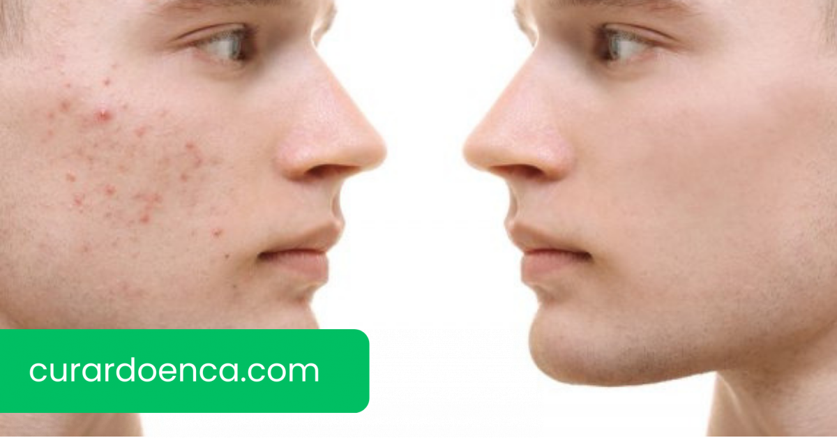 acne (Imagem divulgação)