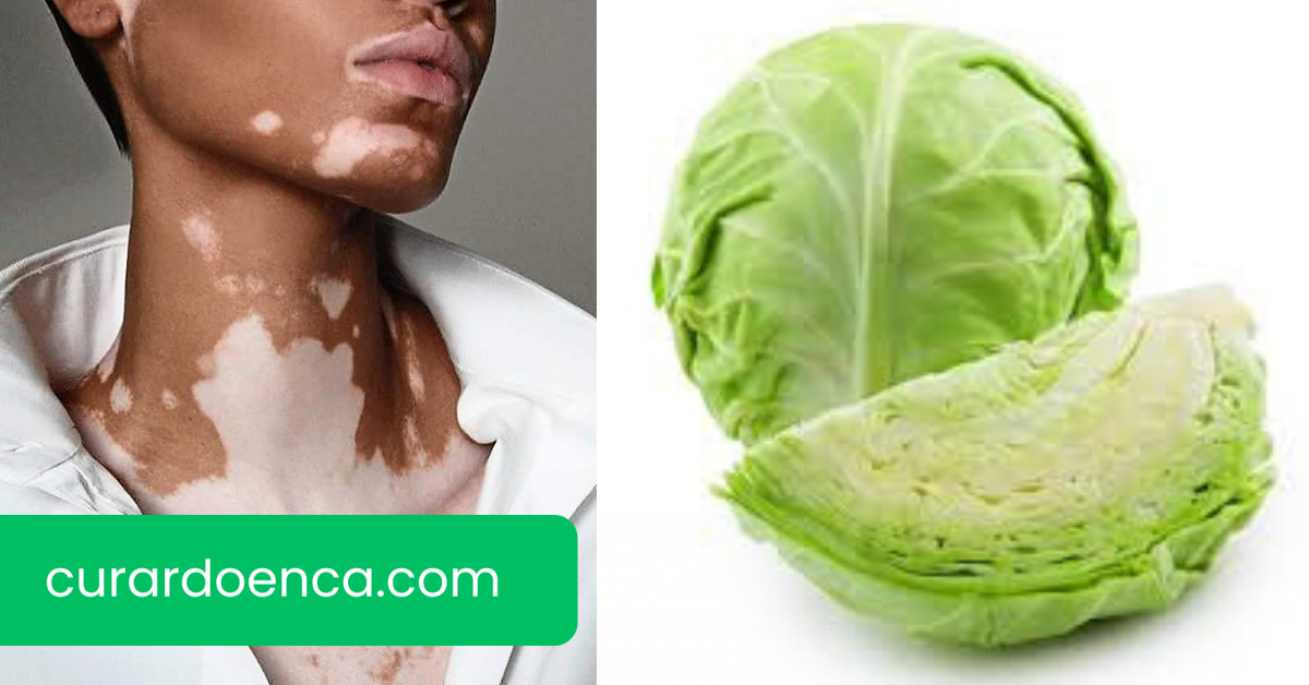 Vitiligo (Imagem divulgação)