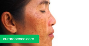 melasma (Imagem divulgação)